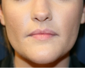 Feel Beautiful - Belotero Lip Augmentation - Before Photo